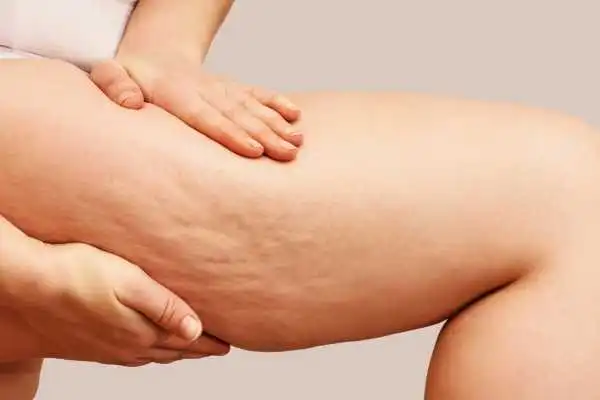 Image of woman showing leg with cellulite Bispham