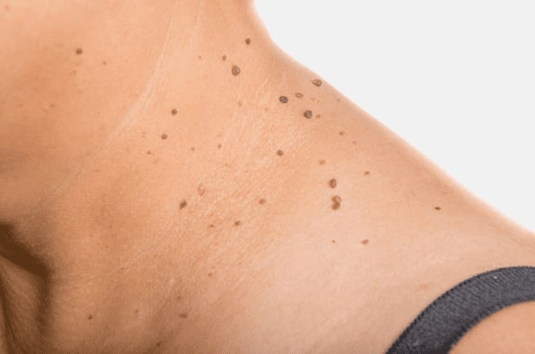 Are you looking for easy skin tag removal Bispham - then contact Spire today!