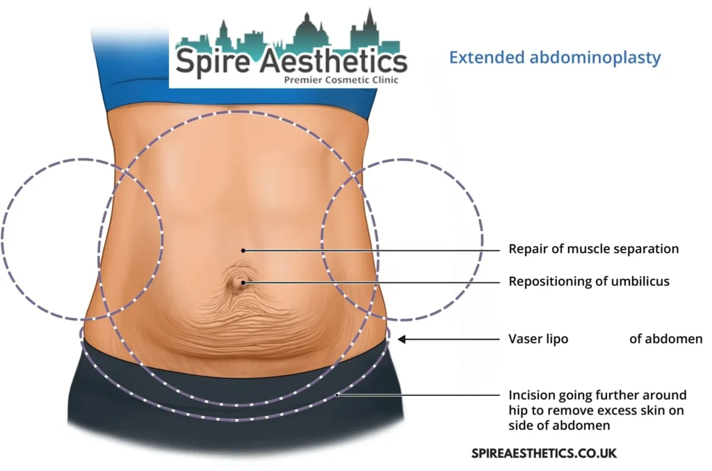 Understanding Loose Skin After Gastric Band Bispham Surgery and HIFU Treatment