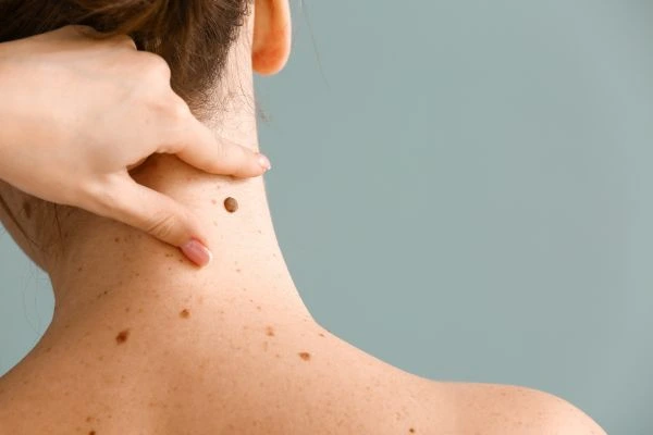skin blemish removal Bispham treatment