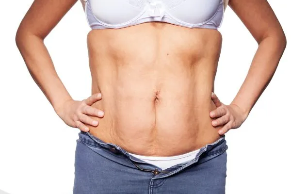 sagging skin on woman's stomach after weight loss injections Bispham