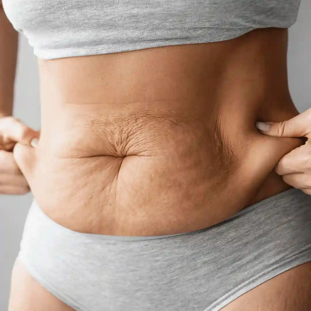 Is It Normal to Have Loose Skin After Pregnancy Bispham?